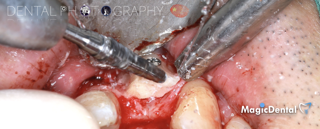 使用自体骨块移植进行牙槽嵴增量: