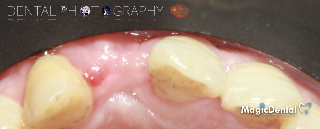 使用自体骨块移植进行牙槽嵴增量: