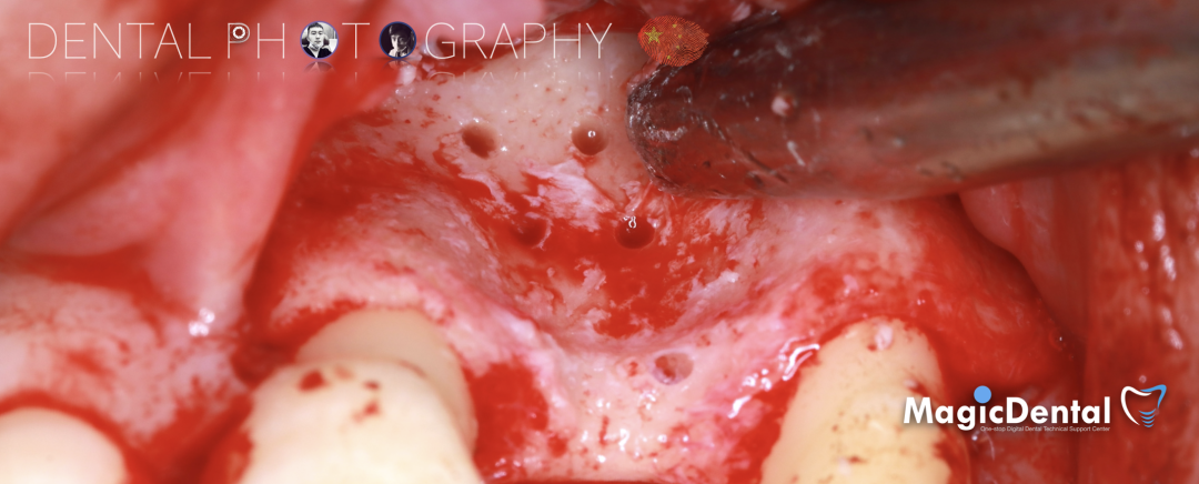 使用自体骨块移植进行牙槽嵴增量: