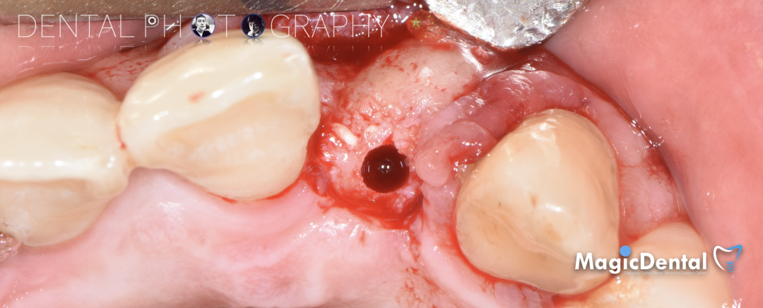 使用自体骨块移植进行牙槽嵴增量: