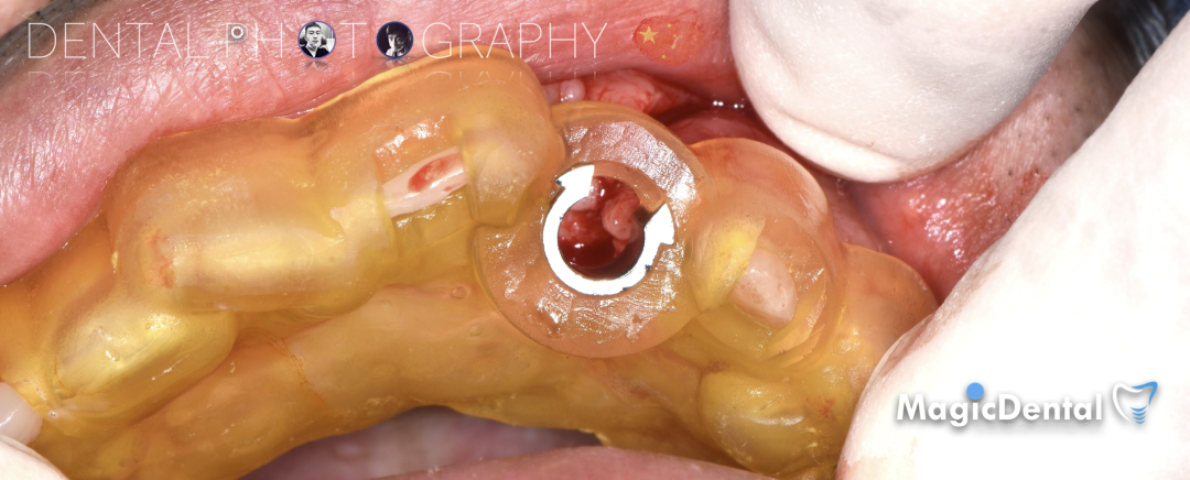 使用自体骨块移植进行牙槽嵴增量: