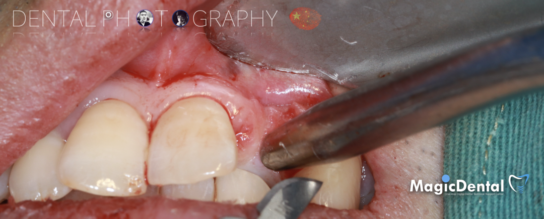 使用自体骨块移植进行牙槽嵴增量: