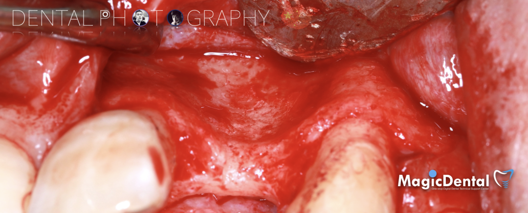 使用自体骨块移植进行牙槽嵴增量: