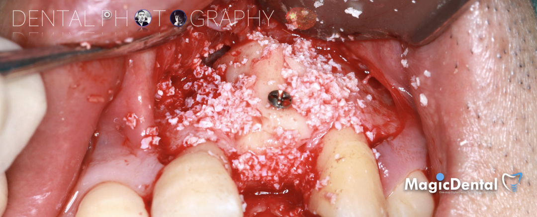 使用自体骨块移植进行牙槽嵴增量: