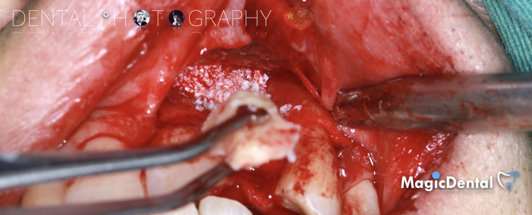 使用自体骨块移植进行牙槽嵴增量: