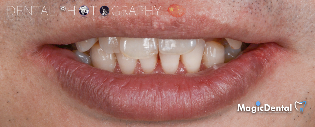 使用自体骨块移植进行牙槽嵴增量: