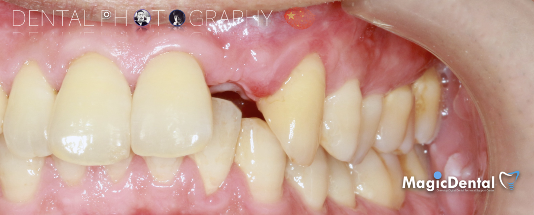 使用自体骨块移植进行牙槽嵴增量: