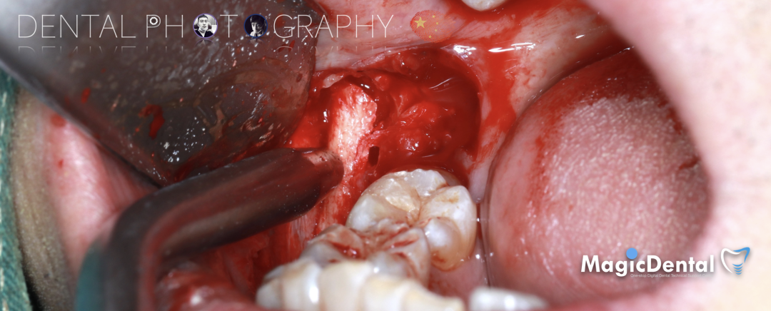 使用自体骨块移植进行牙槽嵴增量: