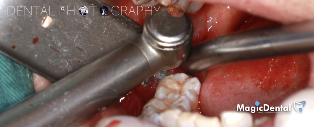 使用自体骨块移植进行牙槽嵴增量: