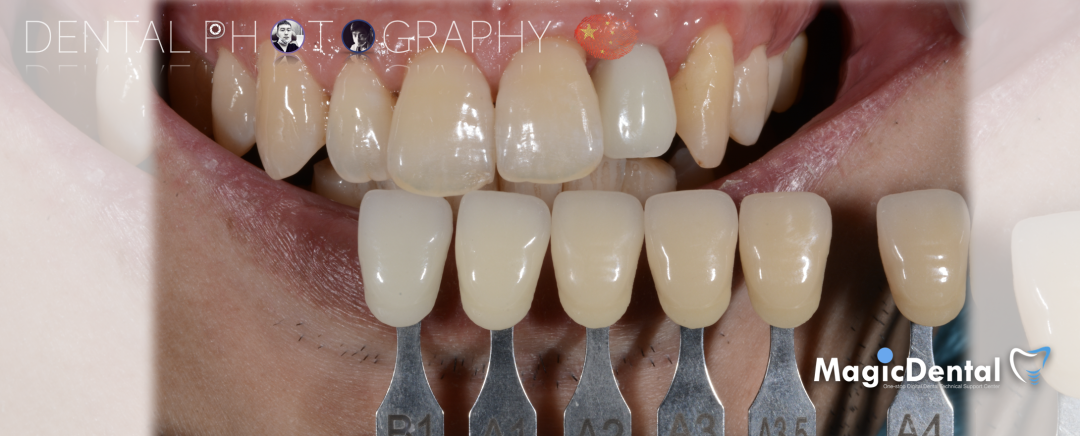 使用自体骨块移植进行牙槽嵴增量: