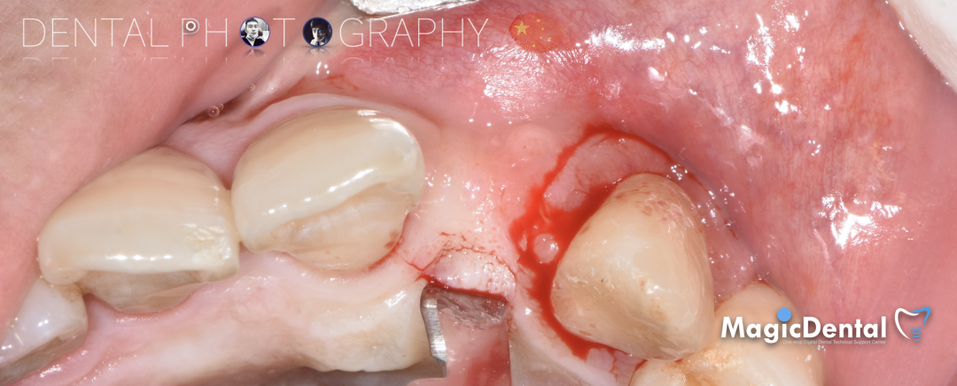 使用自体骨块移植进行牙槽嵴增量: