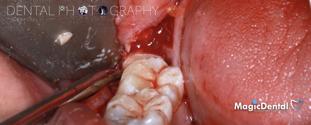 使用自体骨块移植进行牙槽嵴增量: