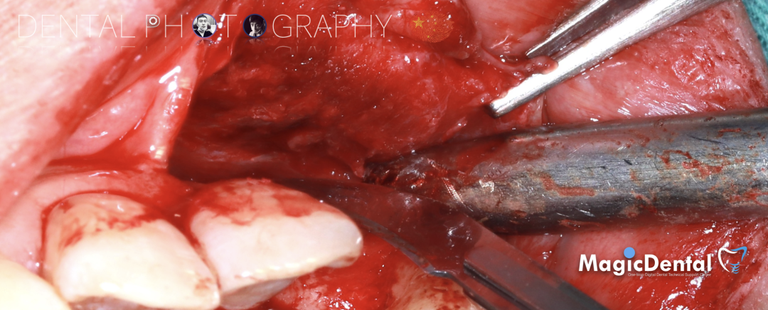 使用自体骨块移植进行牙槽嵴增量: