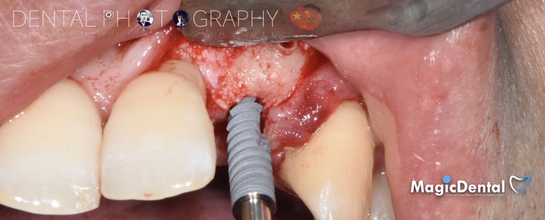 使用自体骨块移植进行牙槽嵴增量: