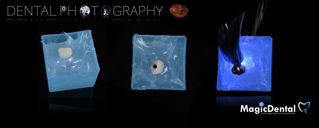 使用自体骨块移植进行牙槽嵴增量: