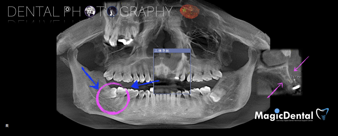 使用自体骨块移植进行牙槽嵴增量: