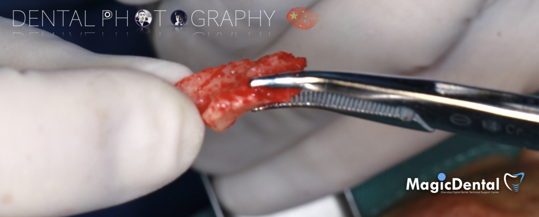 使用自体骨块移植进行牙槽嵴增量: