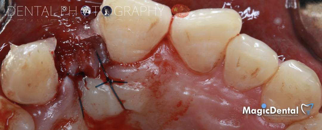 使用自体骨块移植进行牙槽嵴增量: