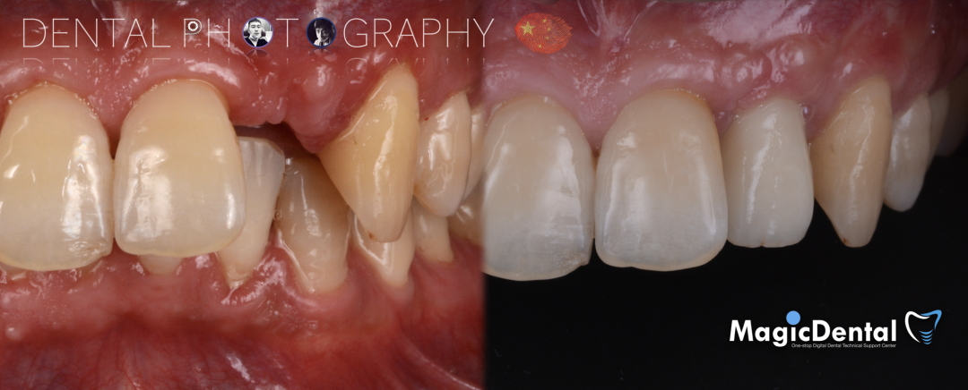 使用自体骨块移植进行牙槽嵴增量: