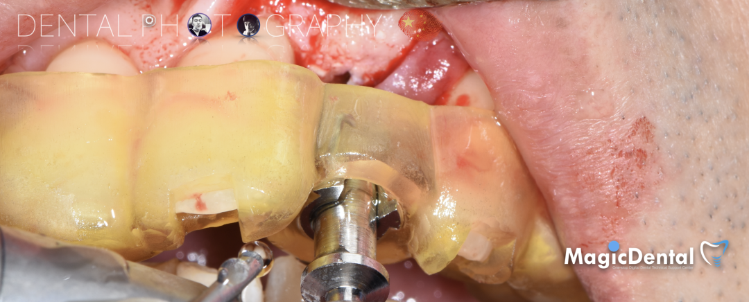 使用自体骨块移植进行牙槽嵴增量: