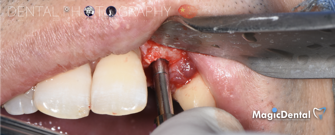 使用自体骨块移植进行牙槽嵴增量: