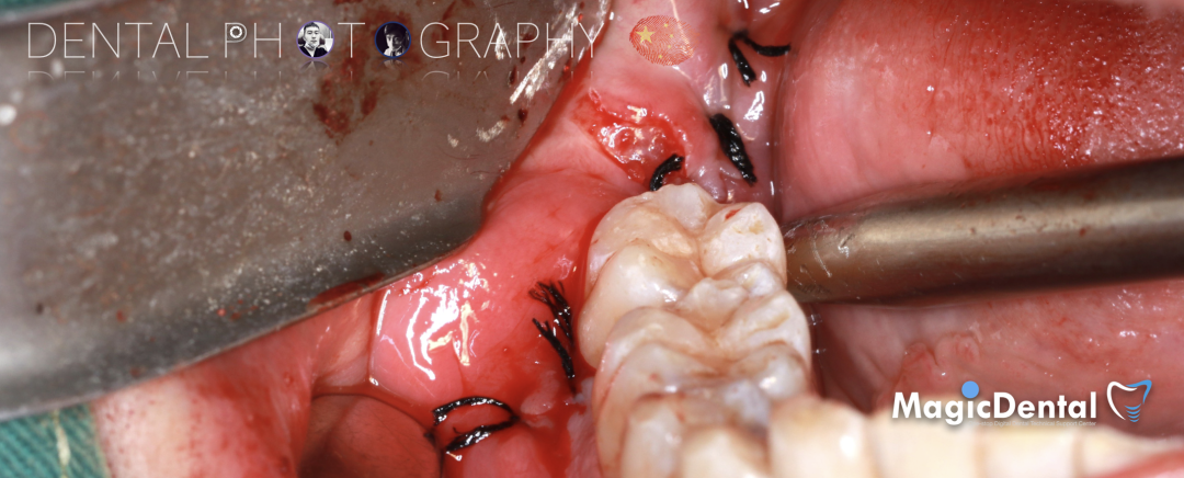 使用自体骨块移植进行牙槽嵴增量: