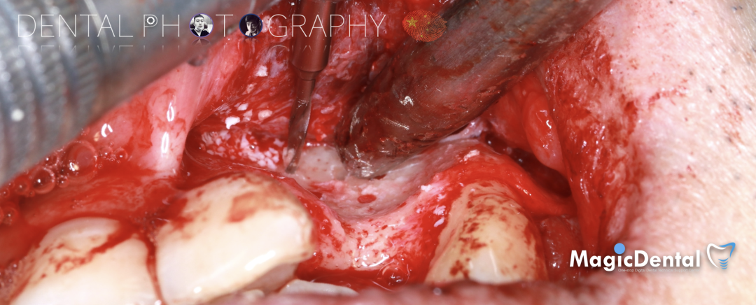 使用自体骨块移植进行牙槽嵴增量: