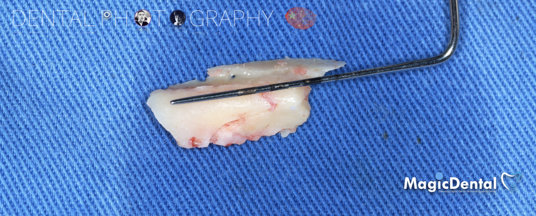 使用自体骨块移植进行牙槽嵴增量: