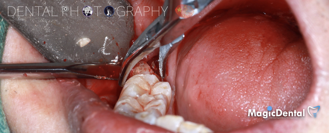 使用自体骨块移植进行牙槽嵴增量: