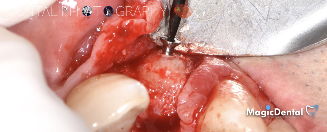 使用自体骨块移植进行牙槽嵴增量: