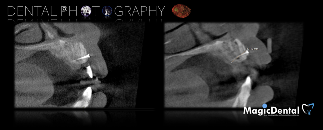 使用自体骨块移植进行牙槽嵴增量: