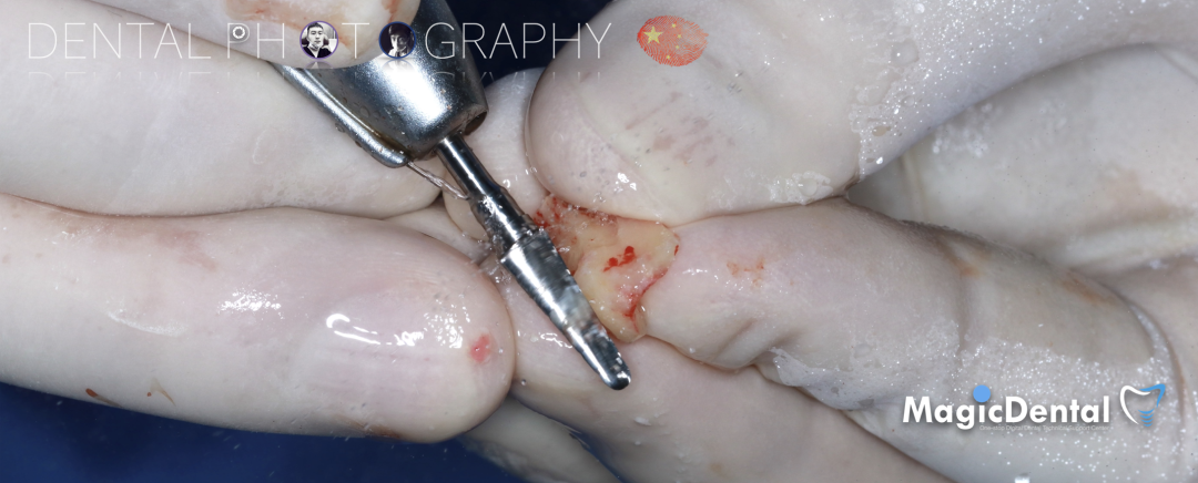 使用自体骨块移植进行牙槽嵴增量: