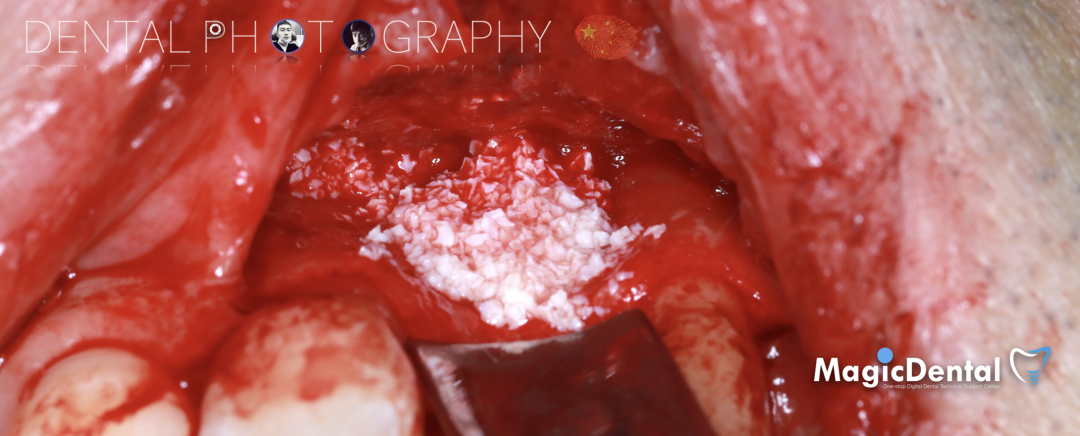 使用自体骨块移植进行牙槽嵴增量: