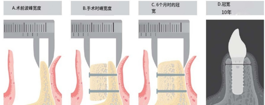 使用自体骨块移植进行牙槽嵴增量: