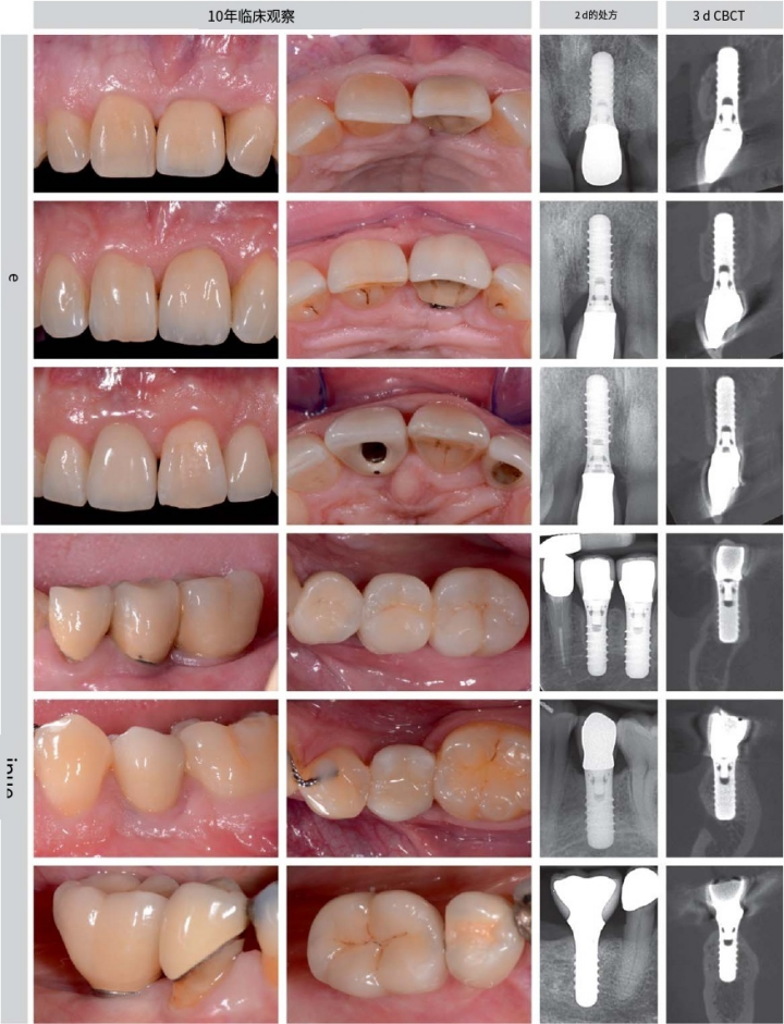 使用自体骨块移植进行牙槽嵴增量:
