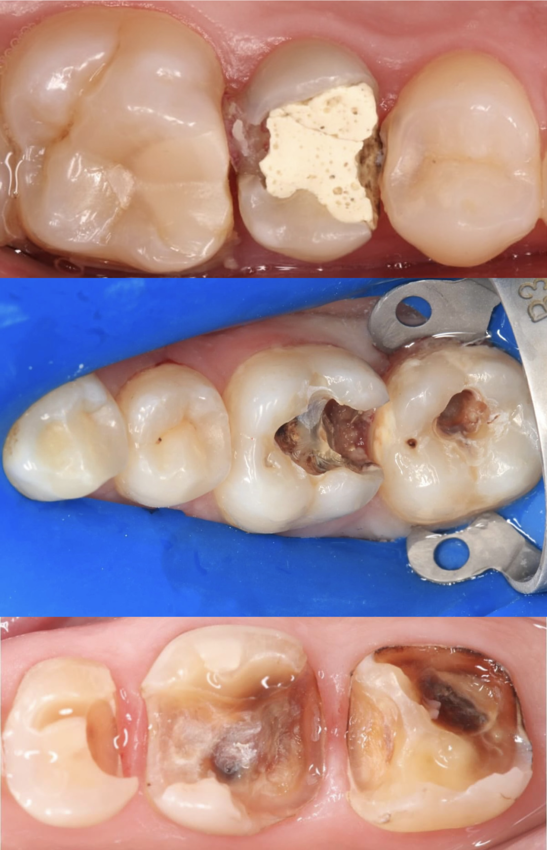 深边缘提升的再思考（龈壁提升的操作细节）
