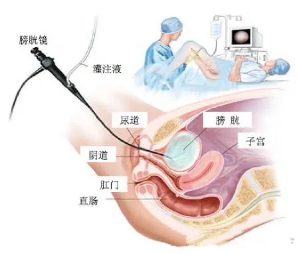 b膀胱镜为什么消毒【健康科普】什么是膀胱镜检查？_https://www.jmylbn.com_新闻资讯_第2张