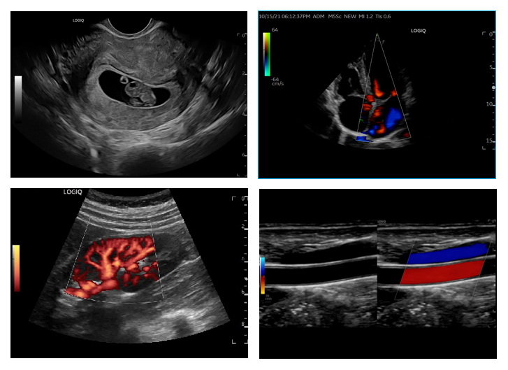 彩超logiq怎么读【为健康护航】进口高端彩超落户乐凯医院，诊疗再添利器_https://www.jmylbn.com_新闻资讯_第3张
