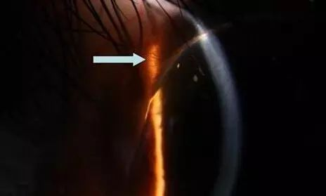 裂隙灯上光源是什么【视光之窗】221期：裂隙灯：被忽视的＂眼表守护神＂_https://www.jmylbn.com_新闻资讯_第3张