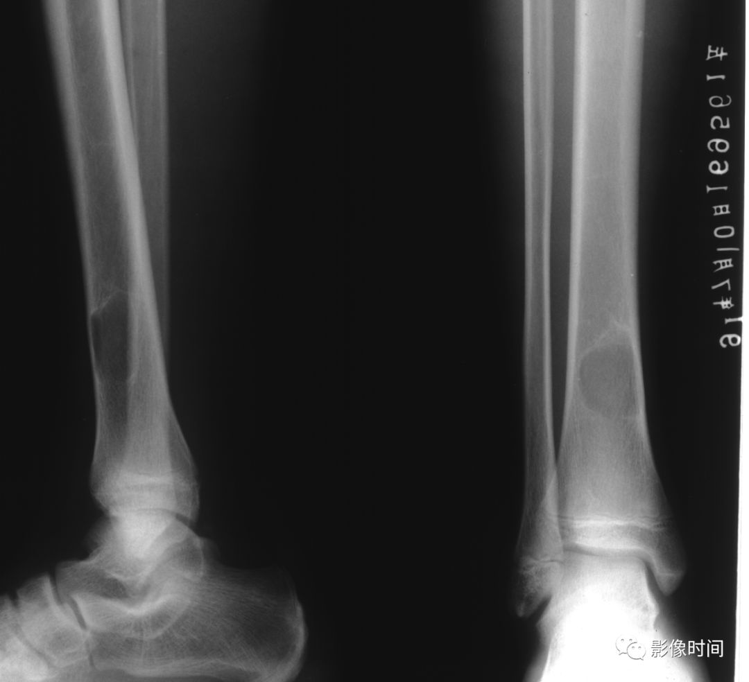 图文解析 骨肿瘤的基本影像表现 骨科时间 微信公众号文章阅读 Wemp