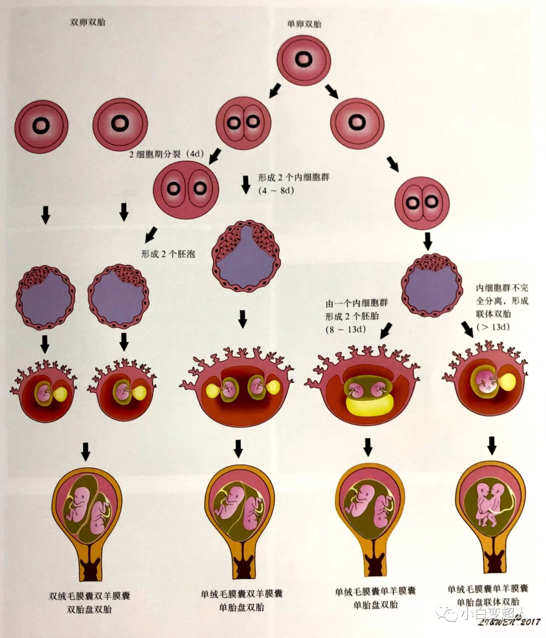 孕早期双胎妊娠绒毛膜囊数与羊膜囊数的确定