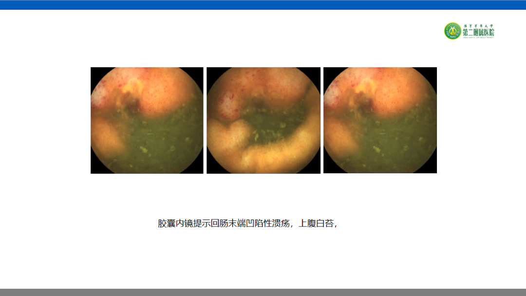 (膠囊內鏡病例)從全球第一顆小腸膠囊內鏡誕生,到金山科技擁有完全