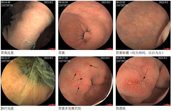 但对普通胃镜检查强烈抗拒,特来医院体检中心进行磁控胶囊胃镜检查