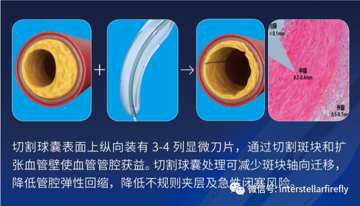 球囊是什么医疗器械医械创新 l乐普医疗：切割球囊系统获批上市，用于冠状动脉血管存在粥样硬化斑块需切割处理的患者－第198期_https://www.jmylbn.com_新闻资讯_第5张