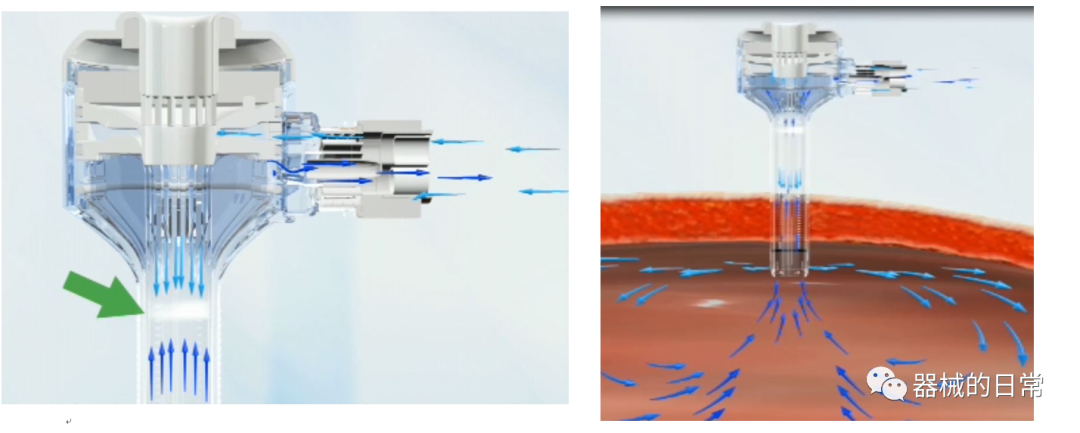 一次性穿刺器是什么一次性使用腹部穿刺器工作原理及结构_https://www.jmylbn.com_新闻资讯_第3张