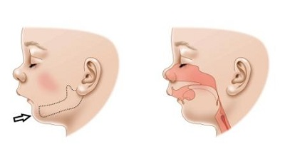 6969小下颌畸形(皮罗氏综合征)是一种以颅面部综合征特征为表现的