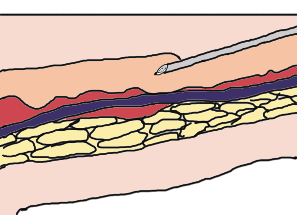 为什么输血不能用小针小时候常打的“屁股针”，为什么现在变少了？_https://www.jmylbn.com_新闻资讯_第10张