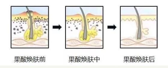 乘风破浪的孟佳张含韵小姐姐力荐,名媛贵妇女星偷用的神器!LITTLETOUCH三代果酸身体乳,去除粗糙/鸡皮,肌肤回复婴儿般娇嫩 乘风破浪的孟佳张含韵小姐姐力荐,名媛贵妇女星偷用的神器!LITTLETOUCH三代果酸身体乳,去除粗糙/鸡皮,肌肤回复婴儿般娇嫩