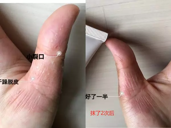 十三姨皲裂霜,百年宝芝灵出品,法国进口骨胶原+三重植物精粹,修皲裂、防冻疮、合裂口、去老茧,滋润补水不油腻,还你少女手足肌 十三姨皲裂霜,百年宝芝灵出品,法国进口骨胶原+三重植物精粹,修皲裂、防冻疮、合裂口、去老茧,滋润补水不油腻,还你少女手足肌