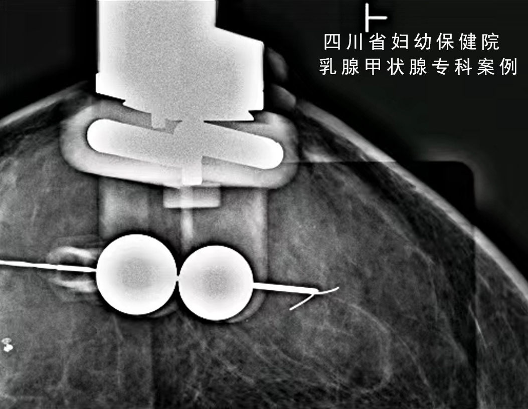 怎么制造手术钩针看医生如何精准“钩出”乳腺钙化灶，将早期乳腺癌“绳之以法”_https://www.jmylbn.com_新闻资讯_第8张